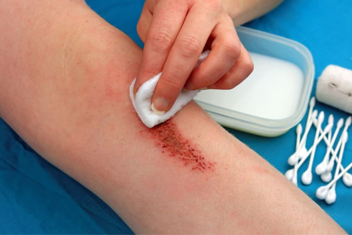 Nếu vết thương chảy máu, hãy dùng bông hoặc gạc vô trùng để ấn nhẹ vào vết thương